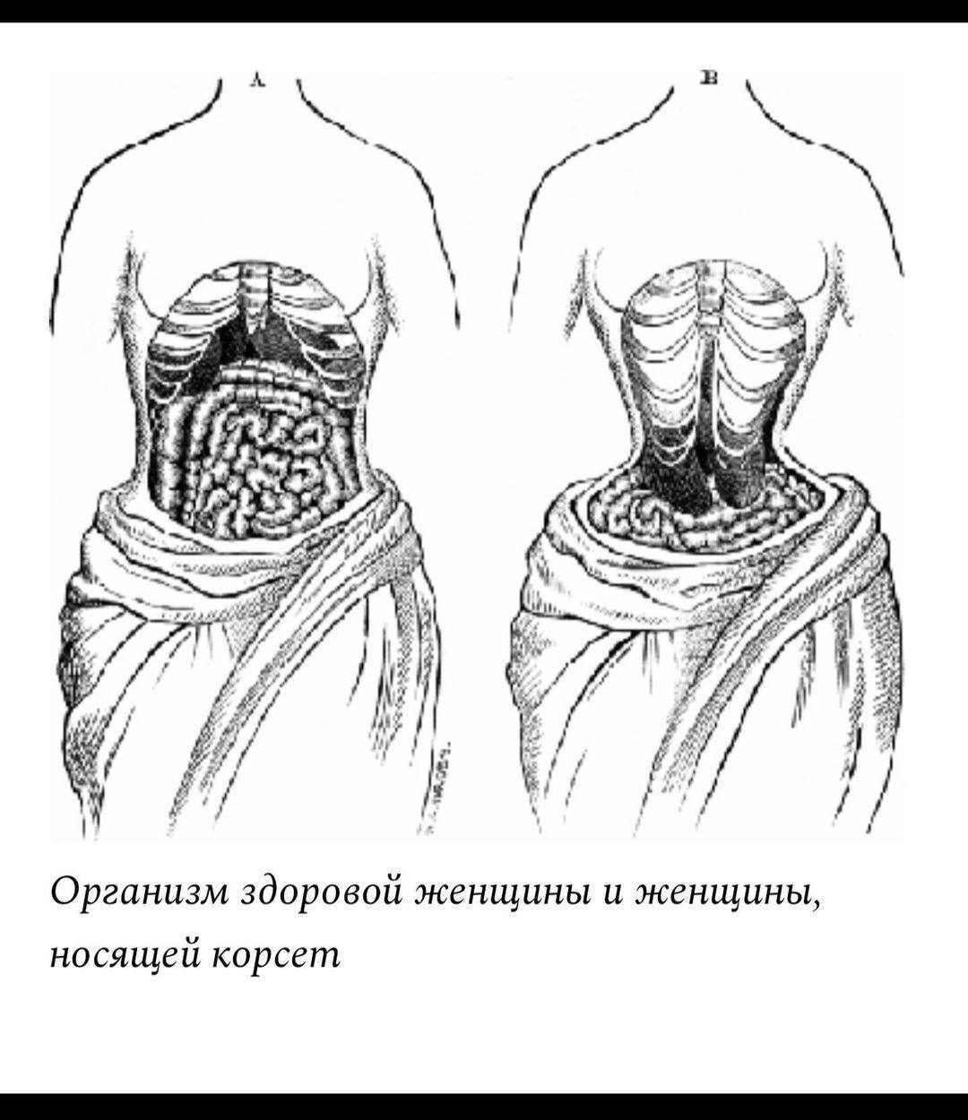 Деформация после корсета