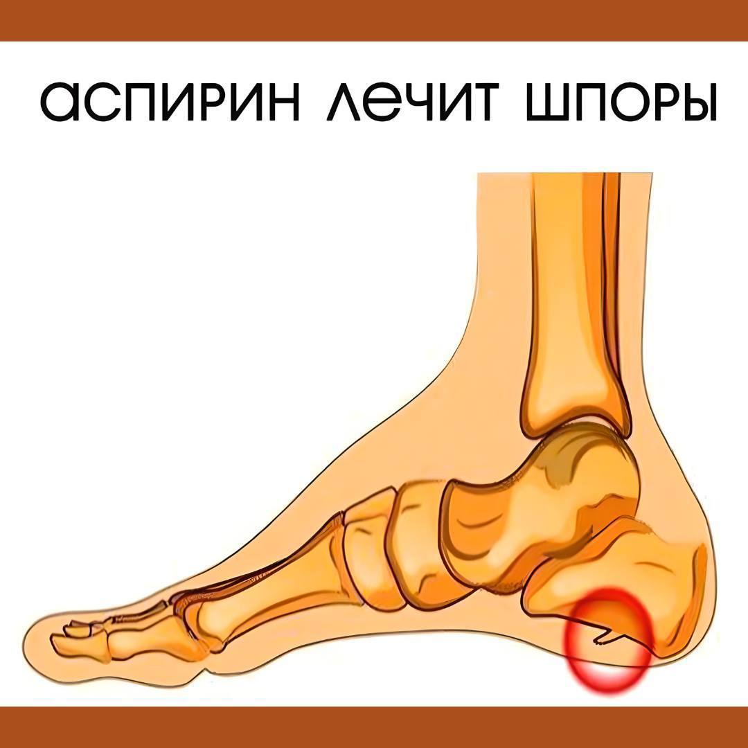 Обострение пяточной шпоры. Пяточная шпора на пятке.